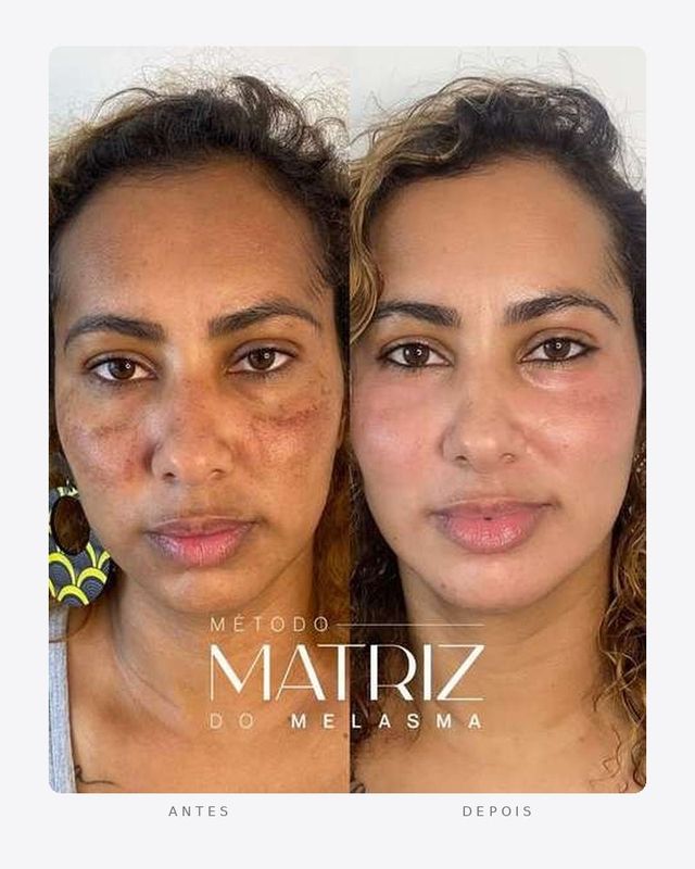 Antes e depois de melasma tratado com o protocolo Matriz do Melasma