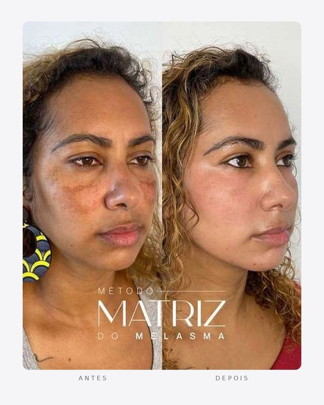 Antes e depois — método matriz do melasma, feminino · perfil direito