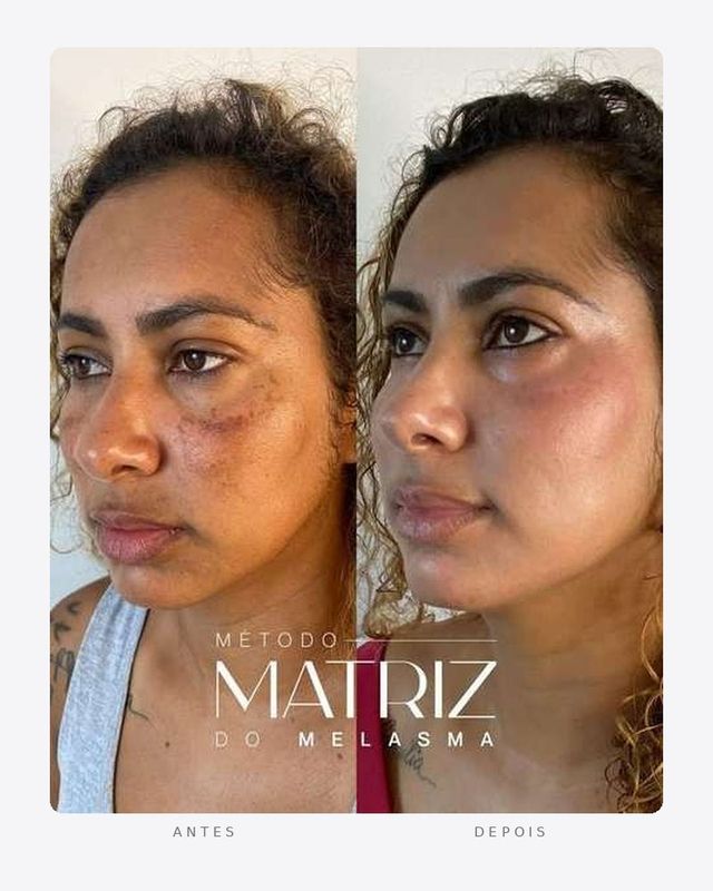Antes e depois — método matriz do melasma, feminino · perfil esquerdo