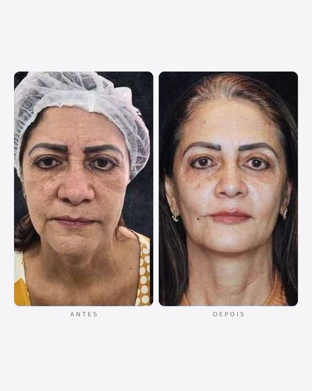 Antes e depois — rejuvenescimento facial, frente