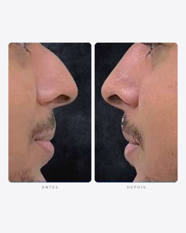 Antes e depois — rinomodelação, perfil
