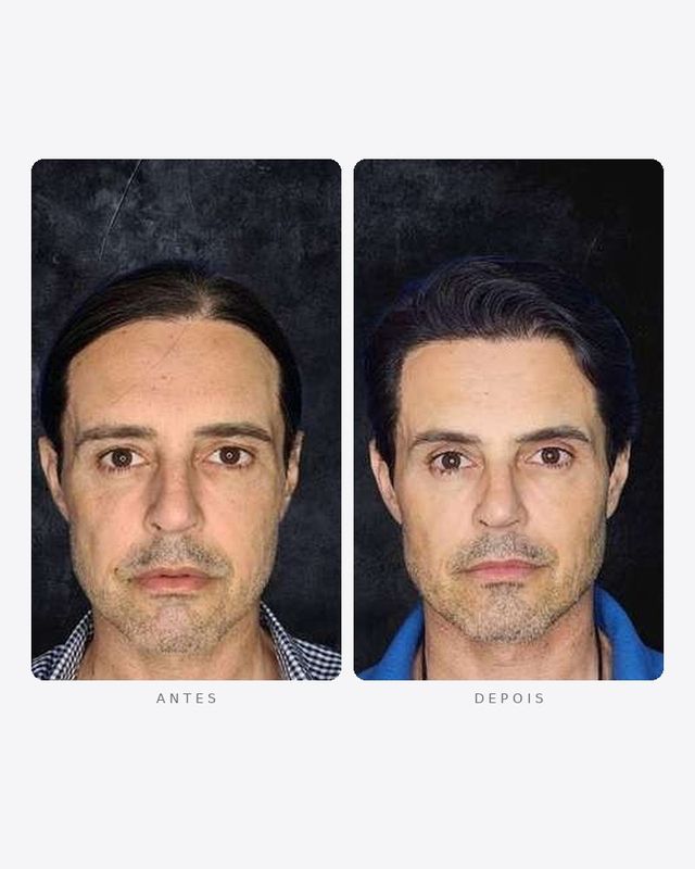 Antes e depois — harmonização facial, masculino · frente