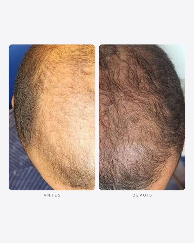Antes e depois — tratamento capilar, vértice