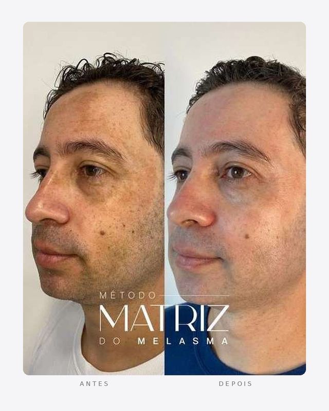 Antes e depois — método matriz do melasma, masculino · perfil esquerdo