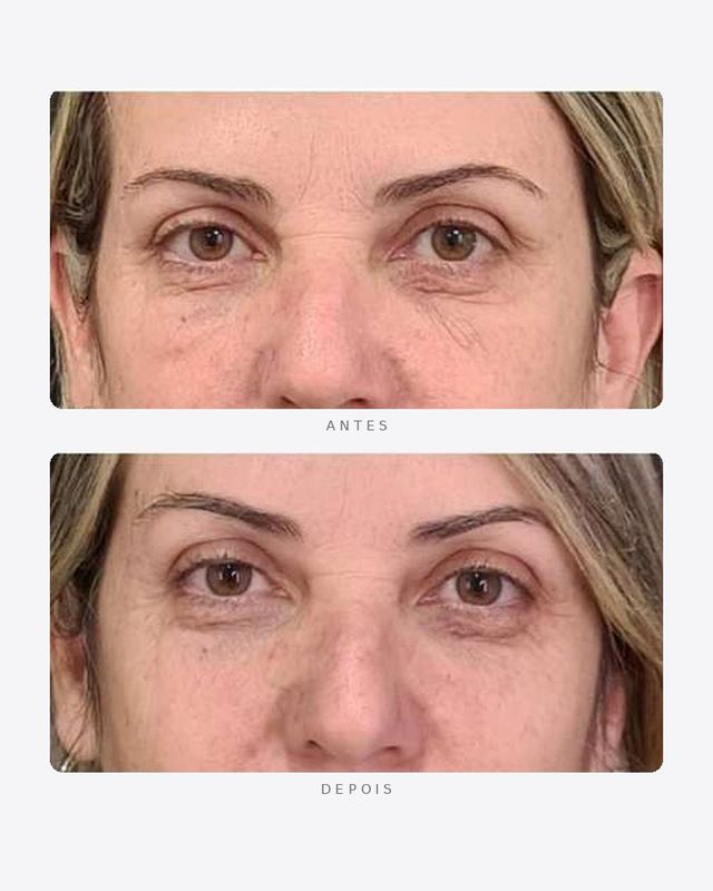 Antes e depois — região periorbital, pálpebras e olheiras · feminino