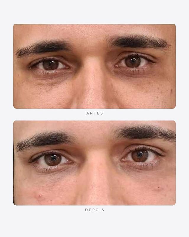 Antes e depois — preenchimento de olheiras, periorbital · masculino