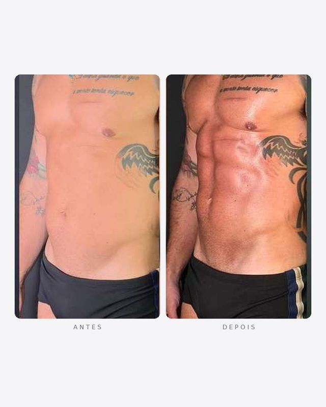 Antes e depois — definição abdominal, masculino · frente