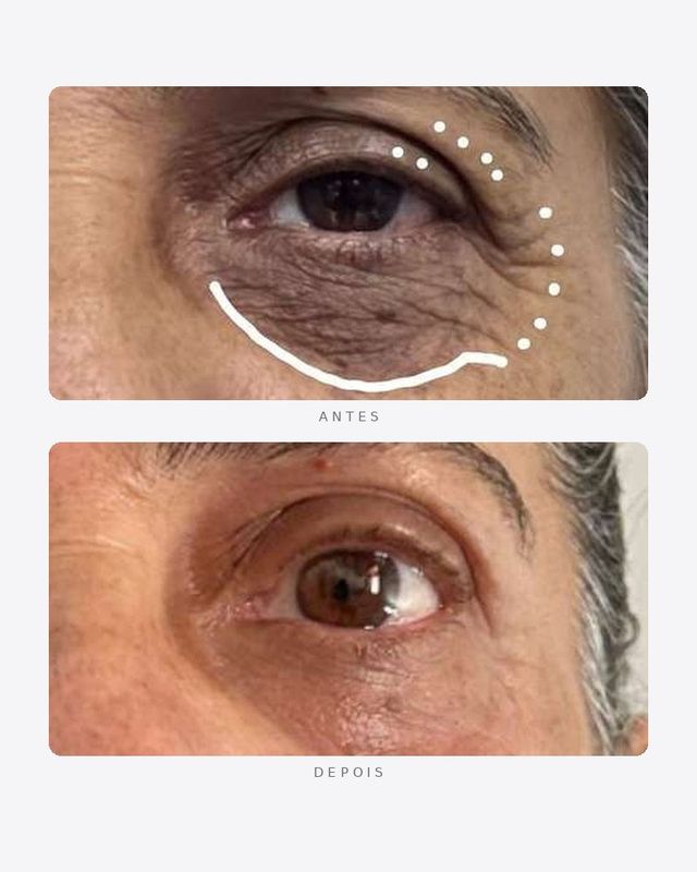 Antes e depois — região periorbital, pálpebras e olheiras · masculino
