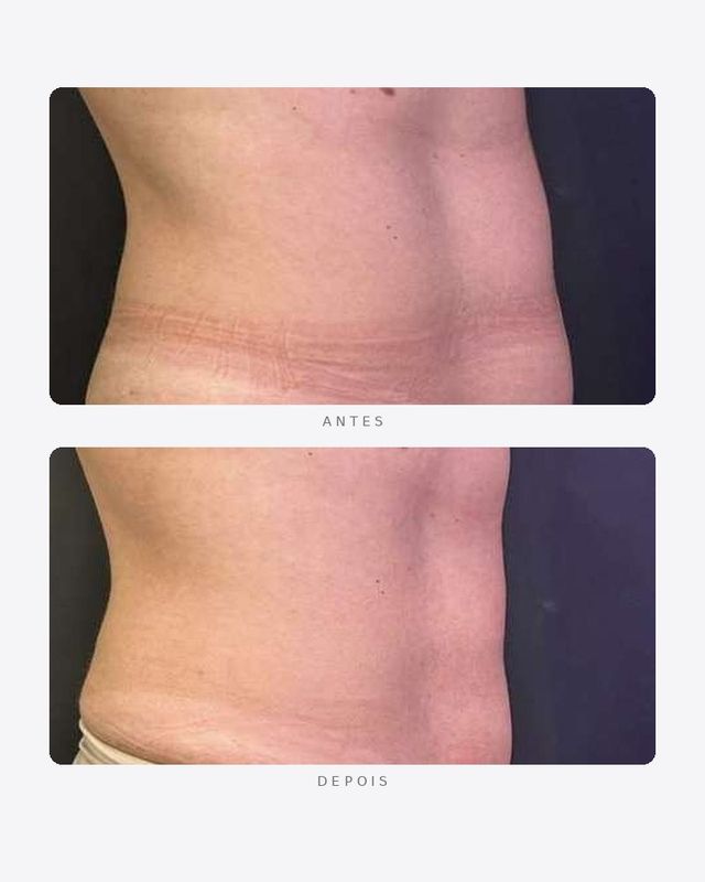 Antes e depois — contorno abdominal — hybrius, feminino · perfil