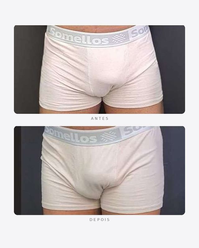 Antes e depois — faloplastia — preenchimento íntimo, masculino · frente · caso 1