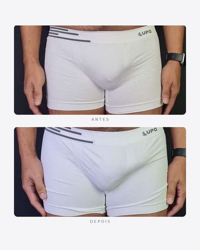 Antes e depois — faloplastia — preenchimento íntimo, masculino · frente · caso 2