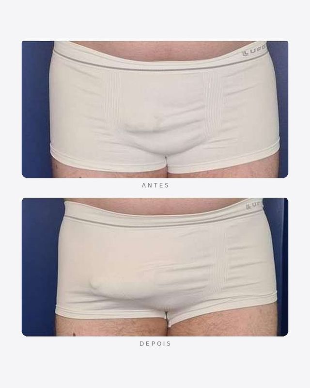 Antes e depois — faloplastia — preenchimento íntimo, masculino · frente · caso 3