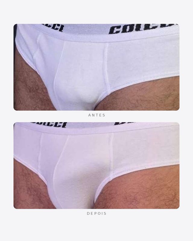 Antes e depois — faloplastia — preenchimento íntimo, masculino · oblíquo