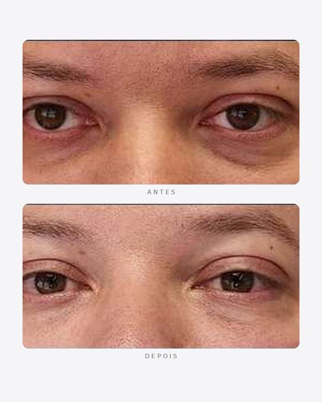 Antes e depois — preenchimento de olheiras, masculino · frente