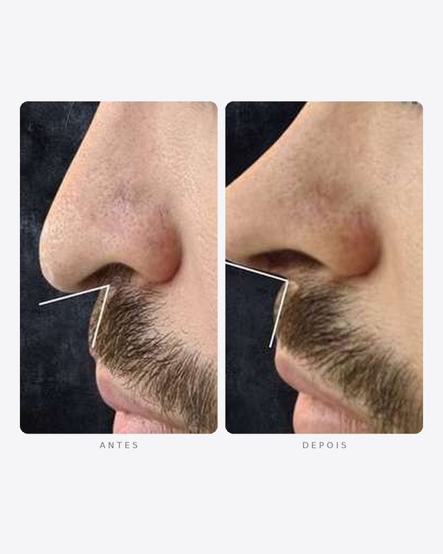 Antes e depois — rinomodelação, masculino · perfil