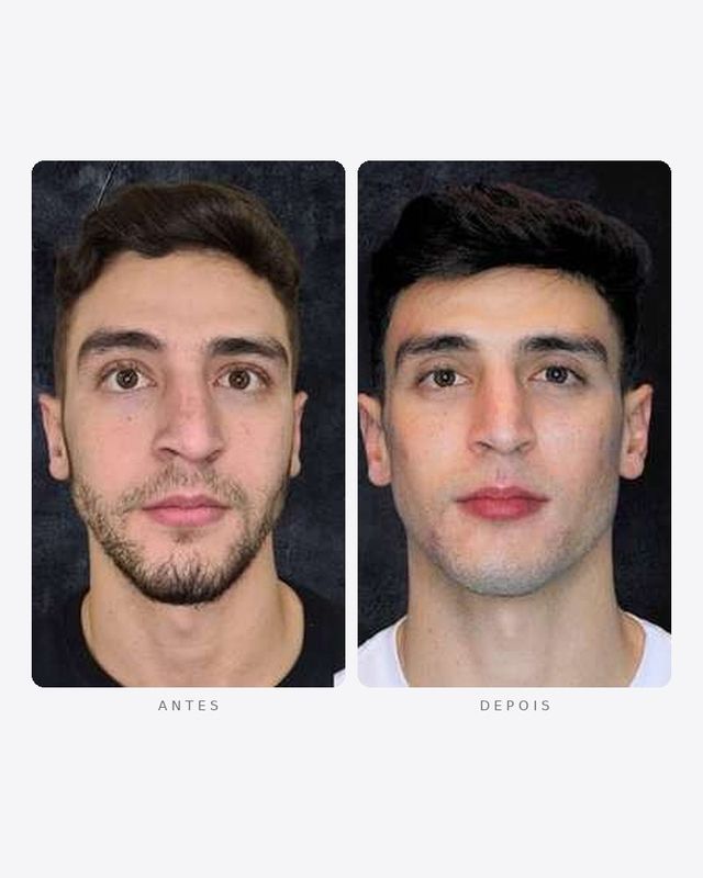 Antes e depois — preenchimento de mandíbula, masculino · frente