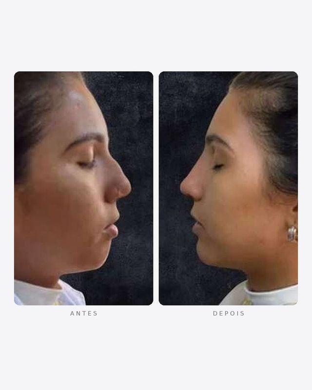 Antes e depois — papada e nariz, feminino · perfil