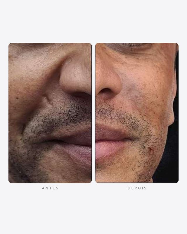 Antes e depois — sulco nasogeniano, masculino · oblíquo