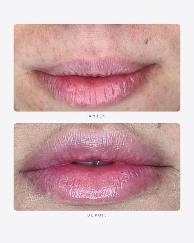 Antes e depois — preenchimento labial, feminino · frente