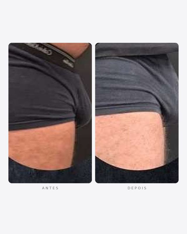 Antes e depois — faloplastia — preenchimento íntimo, masculino · lateral · caso 5