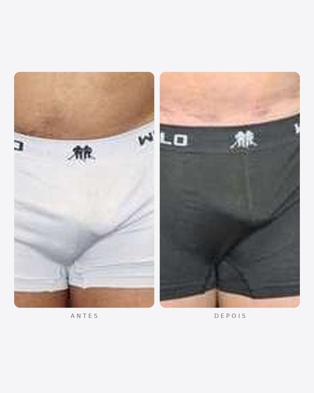 Antes e depois — faloplastia — preenchimento íntimo, masculino · frente · caso 6