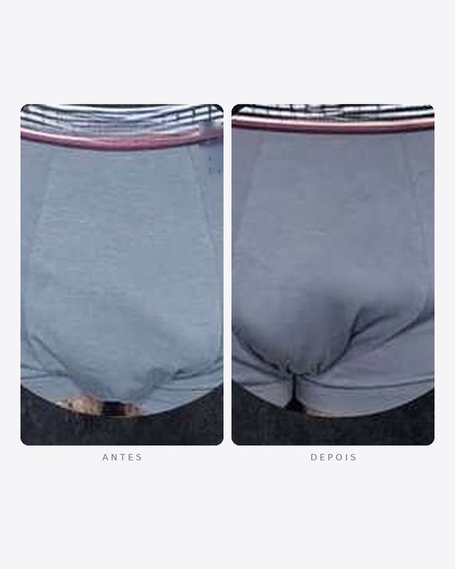 Antes e depois — faloplastia — preenchimento íntimo, masculino · frente · caso 7