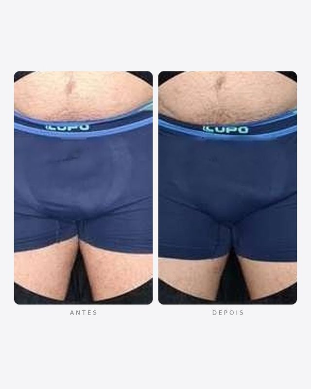 Antes e depois — faloplastia — preenchimento íntimo, masculino · frente · caso 8