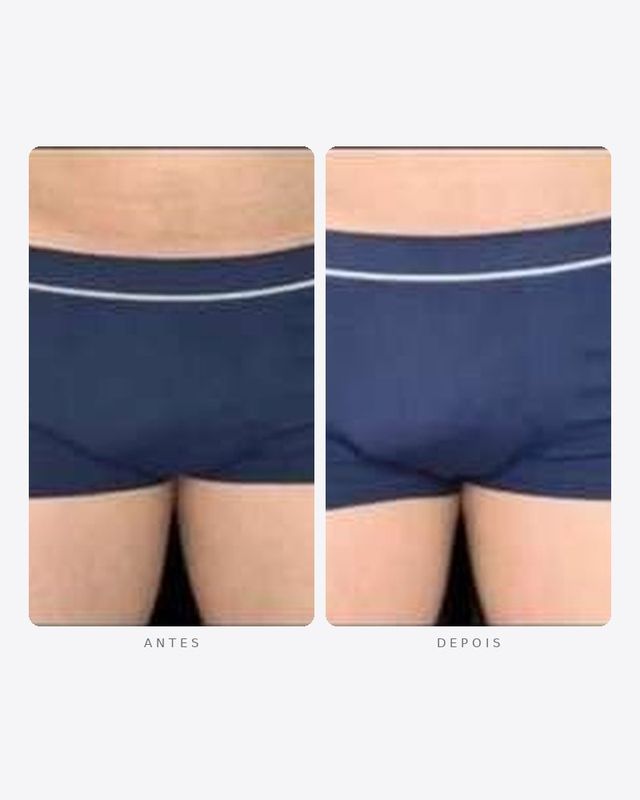 Antes e depois — faloplastia — preenchimento íntimo, masculino · frente e perfil · caso 11