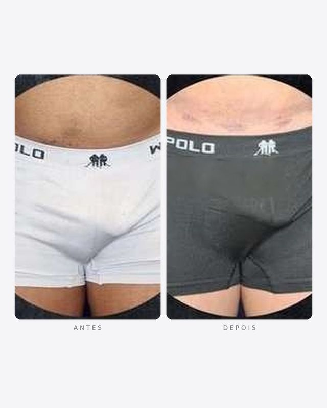 Antes e depois — faloplastia — preenchimento íntimo, masculino · frente · caso 12